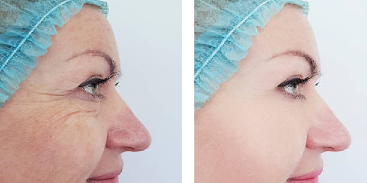 How to Choose the Best Clinic for Tear Trough Filler Treatment in 2024