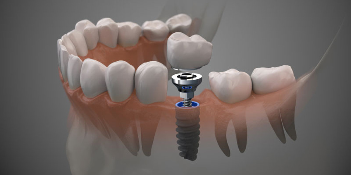 Comprehensive Dental Services in Kew Gardens, NY: From Cleanings to Implants